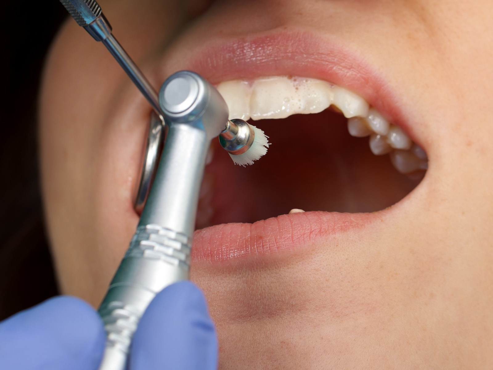 Oral Prophylaxis/Cleaning (Mild)